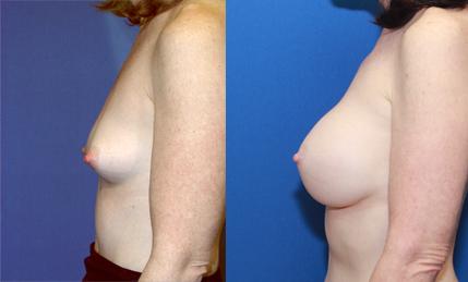 Breast augmentation saline implant full C cup 17 years after